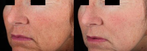 Picosure / Laser Skin Rejuvenation Before and After - skin3