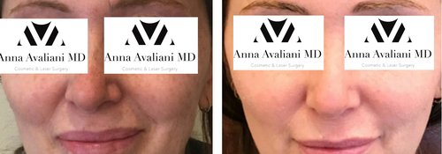 Picosure / Laser Skin Rejuvenation Before and After - skin31