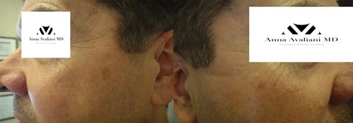Picosure / Laser Skin Rejuvenation Before and After - skin32