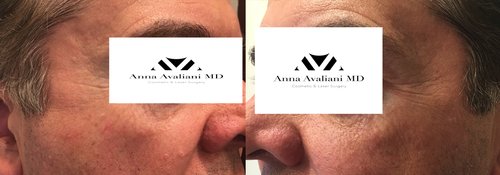 Picosure / Laser Skin Rejuvenation Before and After - skin33