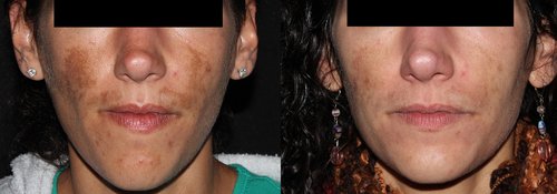 Picosure / Laser Skin Rejuvenation Before and After - skin4