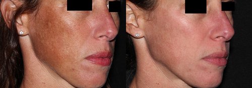 Picosure / Laser Skin Rejuvenation Before and After - skin5