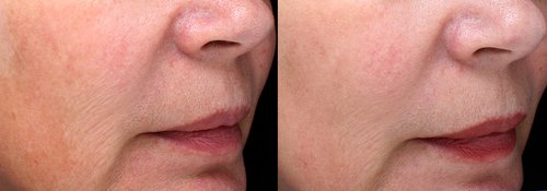 Picosure / Laser Skin Rejuvenation Before and After - skin6