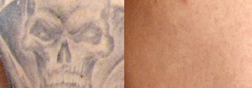 Tattoo Removal Before and After - tatto1