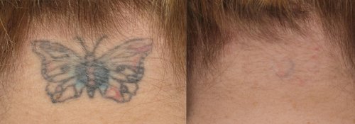 Tattoo Removal Before and After - tatto2