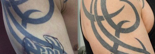Tattoo Removal Before and After - tatto3