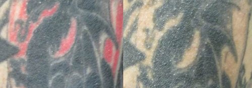 Tattoo Removal Before and After - tatto4