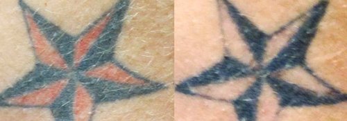 Tattoo Removal Before and After - tatto5
