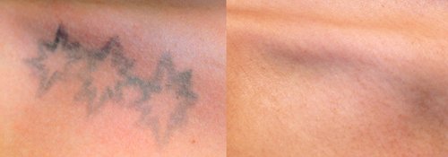 Tattoo Removal Before and After - tatto6