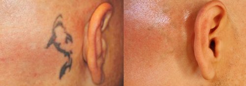 Tattoo Removal Before and After - tatto7