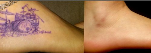 Tattoo Removal Before and After - tatto8