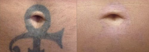 Tattoo Removal Before and After - tatto9