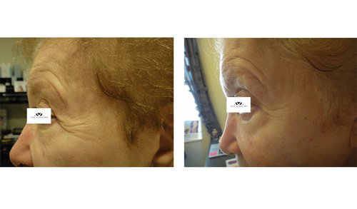 Ulthera Before and After - u11