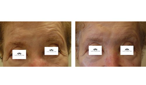 Ulthera Before and After - u12