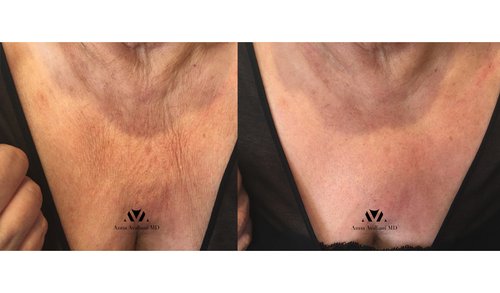 Ulthera Before and After - u13