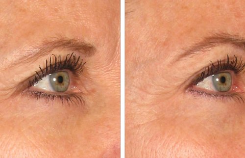 Ulthera Before and After - u2