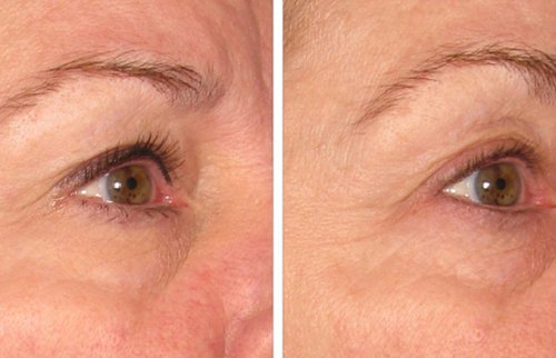 Ulthera Before and After - u3