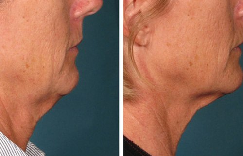 Ulthera Before and After - u4