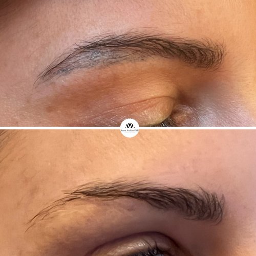 Tattoo Eyebrow Removal Before and After - v7qZQpBLmYbiasJHqv9ggPCpBsMALKUO2A