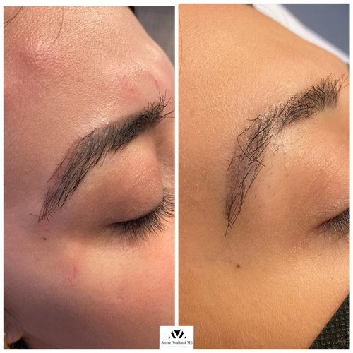 Tattoo Eyebrow Removal Before and After - xVKb8VbR n9d75LXBfLY-urLMZAmqRCKqA