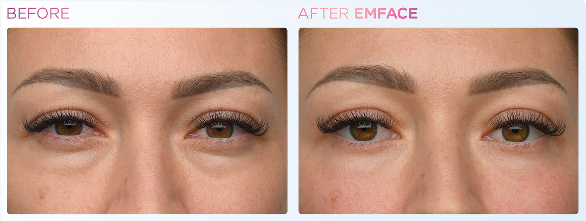 Emface_eye